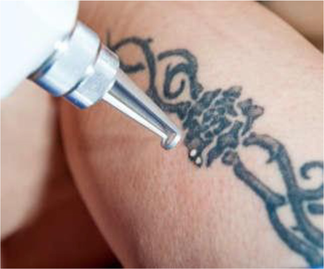 使用電光調制器或基于普克爾盒的激光調制去除紋身